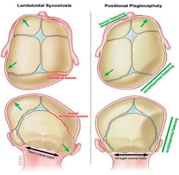 plagiocéphalies